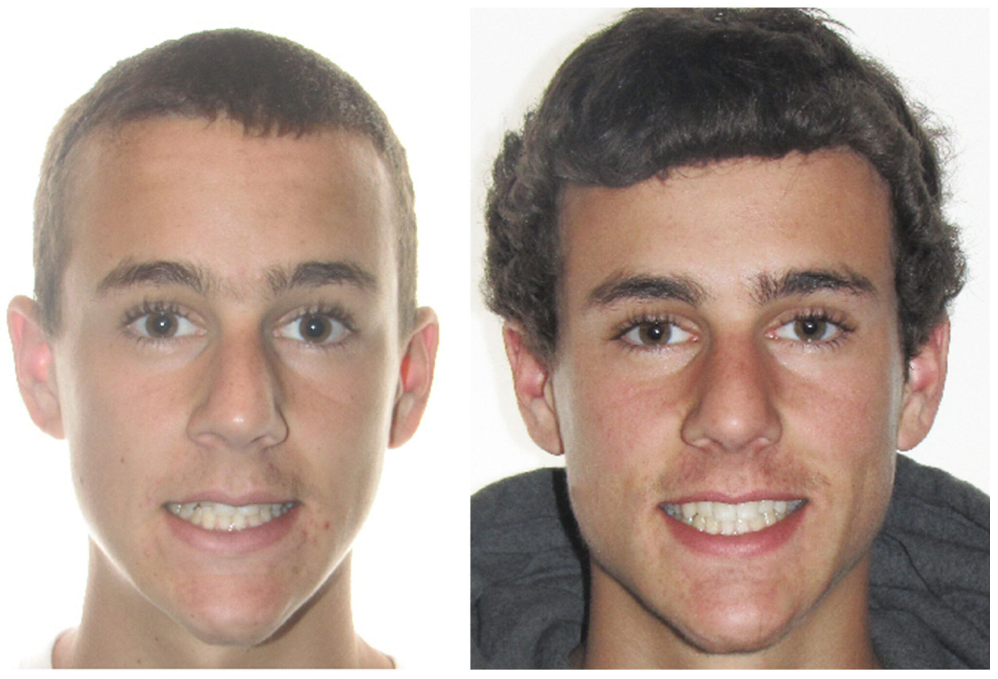Invisalign clear aligners