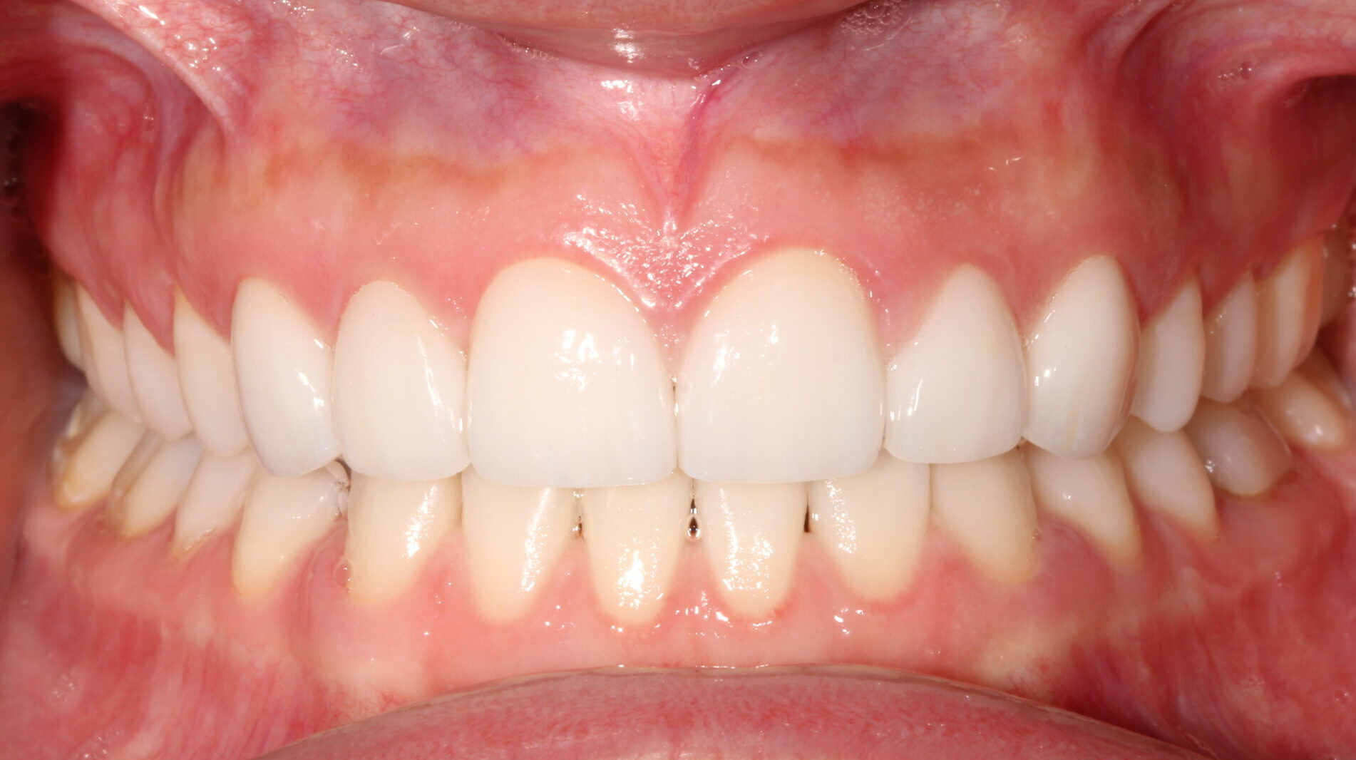 After cosmetic veneers