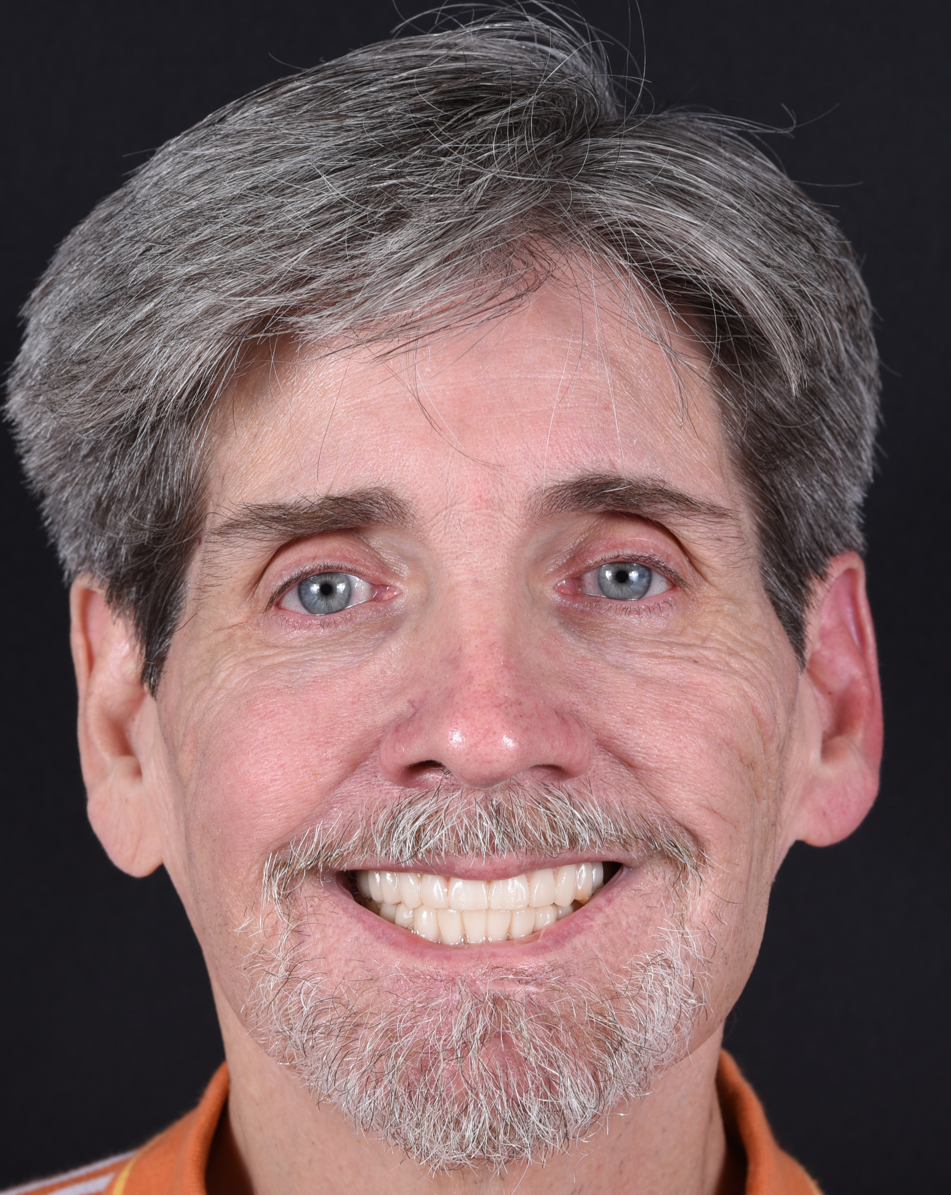 Dental implants